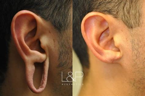 Earlobe Repair Before and After Photo Gallery | Palo Alto & San Jose, California | L&P Aesthetics