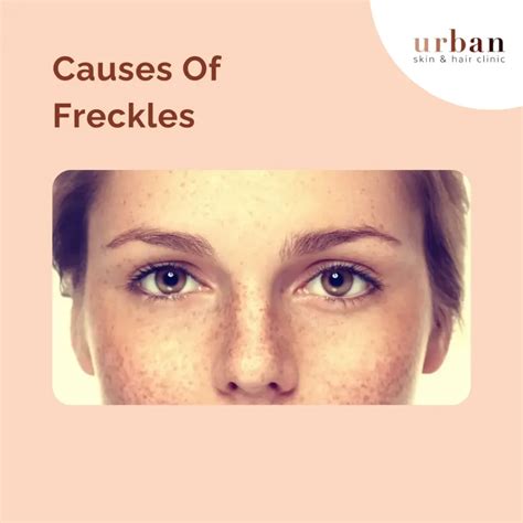 Freckles Types, Causes, Symptoms & Treatment | USHC
