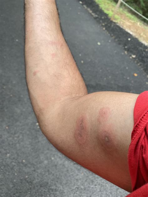 Ring worm or poison ivy infection? : r/skin