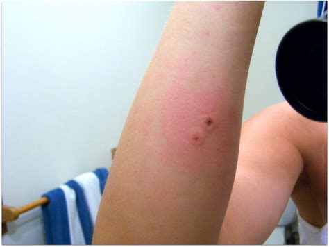 House Centipede Bite Marks - hhousehrh