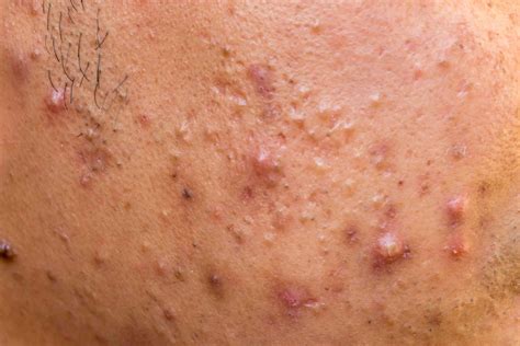 What Nodular Acne Looks Like and How It's Treated