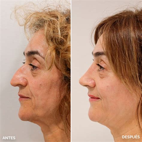 Rinoplastia en Barcelona · Cliníca Tintoré