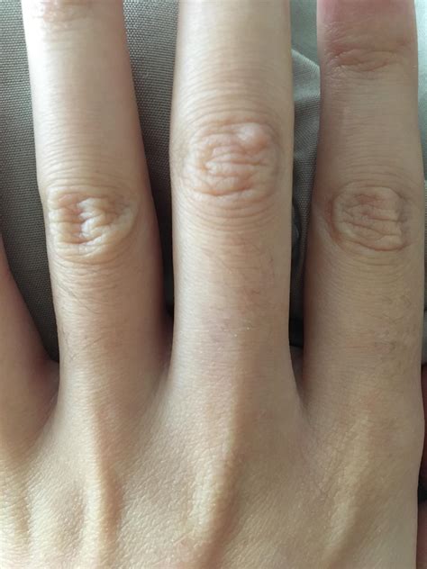 Painful Bumps On Finger – Lump On Finger – AGINZ