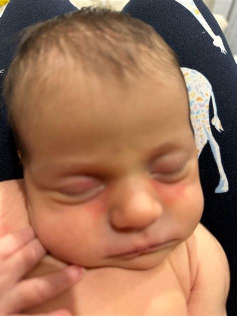 Newborn red eye : r/pediatrics