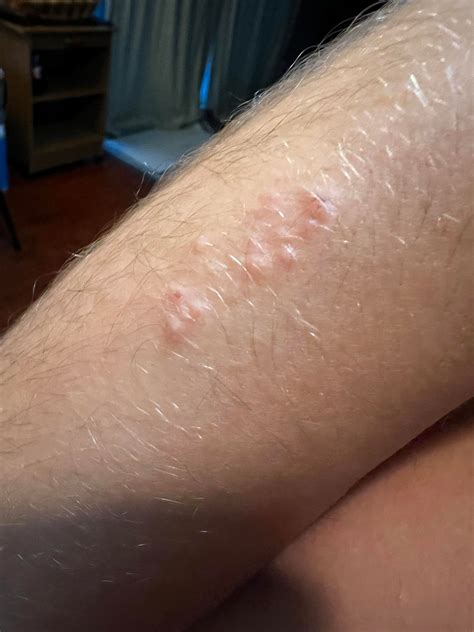 Lesion to scar progression (final update) : r/monkeypoxpositive