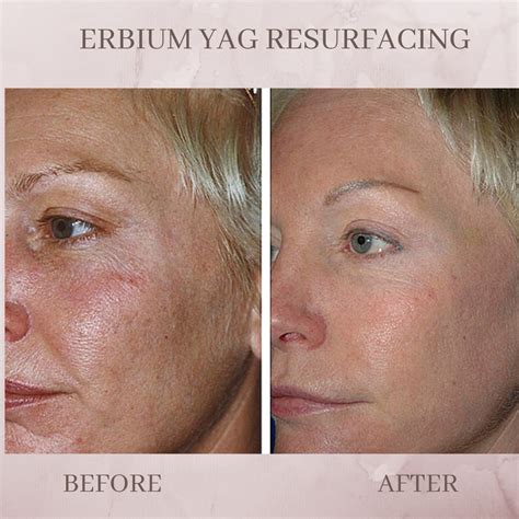 Erbium Laser Resurfacing