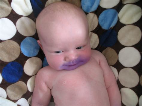 Gentian Violet And Thrush