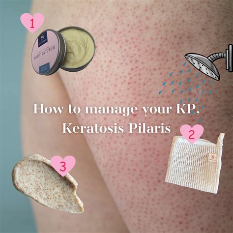 What is Keratosis Pilaris and How To Manage It