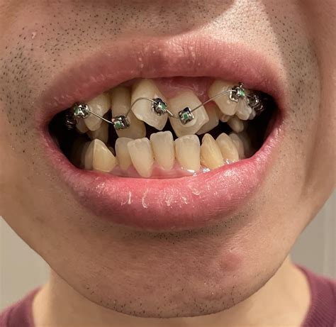 Unhealthy Teeth With Braces Braces Wax: Why And When To Use It