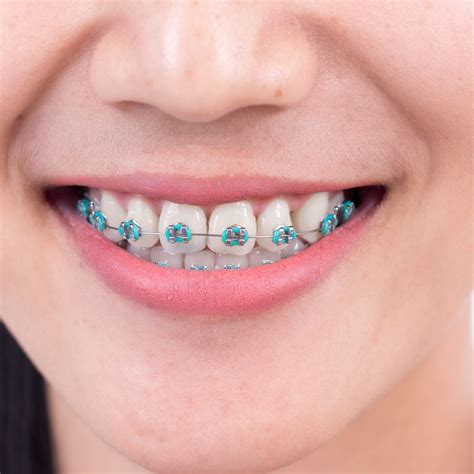 Types Of Permanent Retainers After Braces at David Masterson blog