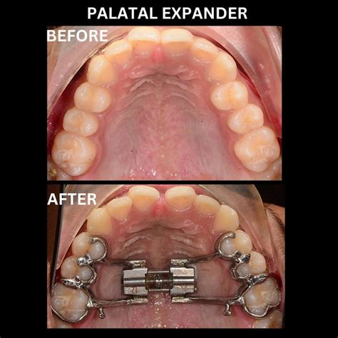 Palate Expander Kids