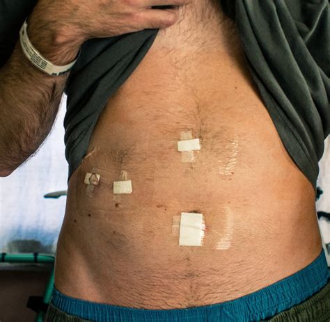 Gallbladder Surgery Recovery Time - HubPages