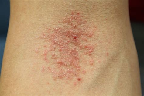 Itchy Elbow Rash Causes at Chana Ryan blog