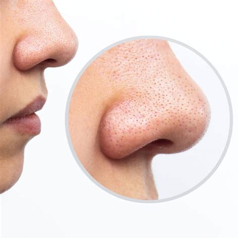 Sebaceous Filaments vs Blackheads: How to Identify and Treat