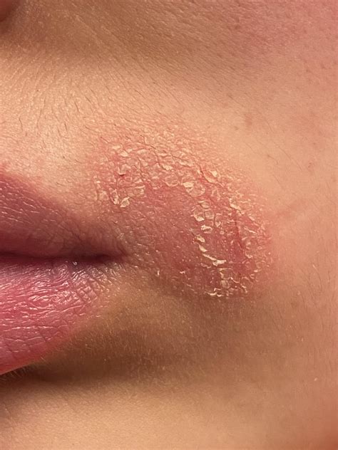 Recurring dry patch next to mouth? : r/Skincare_Addiction