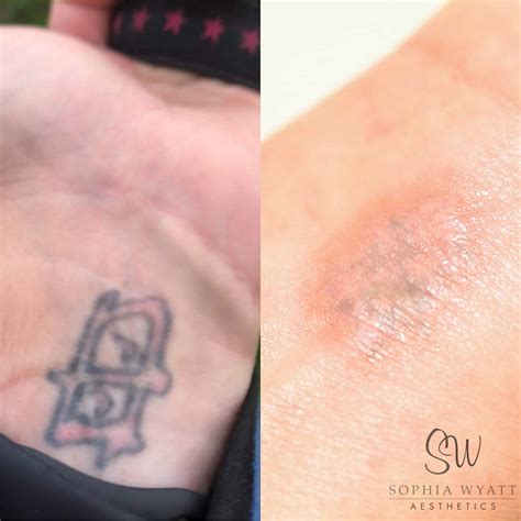 Tattoo Removal Before And After Scar