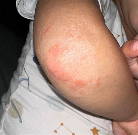 3 year old bilateral elbow rash : r/DermatologyQuestions