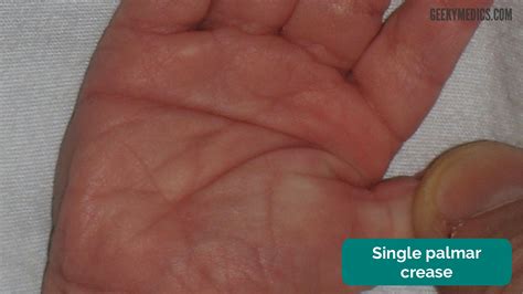 Newborn Baby Assessment (NIPE) - OSCE Guide | Geeky Medics