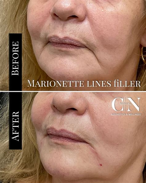 CN MEDICAL AESTHETICS & WELLNESS | Marionette Line Fillers: Before & After Smooth away deep ...