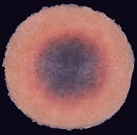 Deep Tissue Injury - Techline Trauma