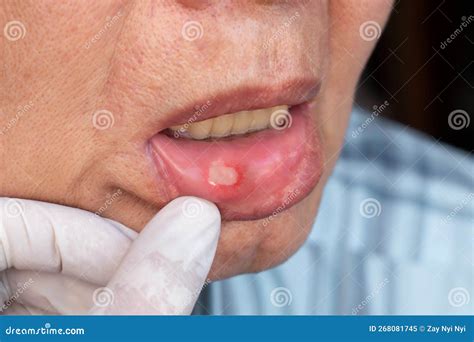 Aphthous Ulcer, Canker Sore or Stress Ulcer in the Mouth Stock Image - Image of erythematous ...