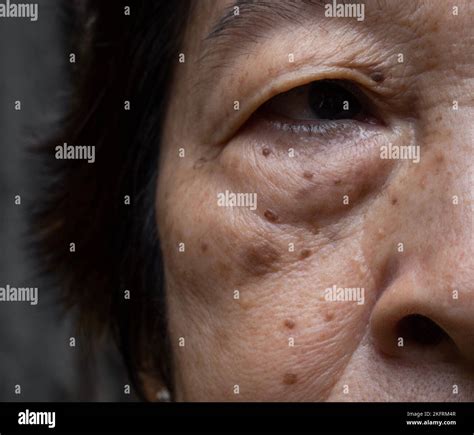 Small brown patches called age spots on face of Asian elder woman. They are also called liver ...