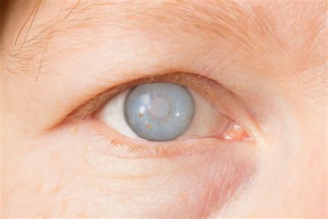 Cataract Treatment – Bombay City Eye Institute