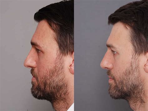Men's Nose Surgery