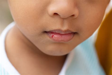 Chapped Lips in Children: Causes and Recommendations