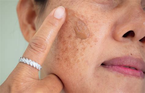 Why am I getting Dark Spots on my face? — GMARO Magazine | Fashion ...