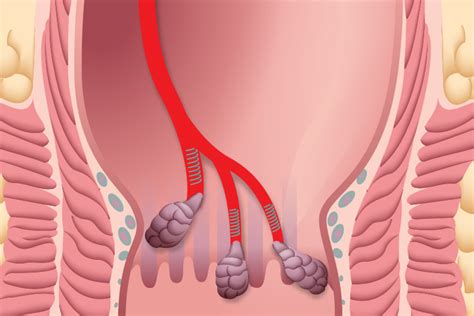 Hemorrhoidal artery embolization a nonsurgical approach to internal hemorrhoids treatment | UCLA ...