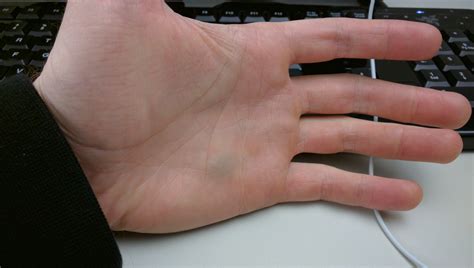 What's wrong with my hand? (bruise on palm, left of ringfinger/pinky) : r/climbing