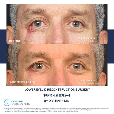 Lower Eyelid Surgery Before And After | Eastern Plastic Surgery