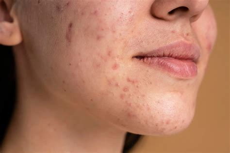 7 Causes of Cheek Acne Appearing in the Same Spot