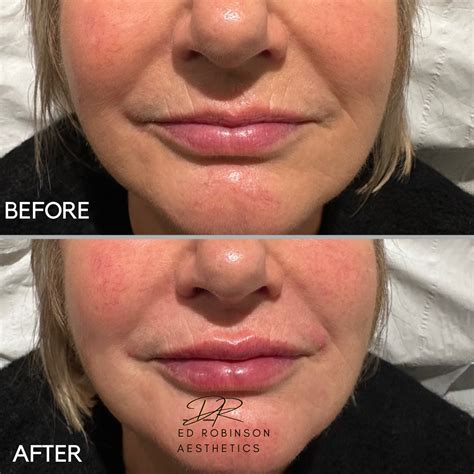 Smokers Lines | Lipstick Lines — Dr Ed Robinson Aesthetics