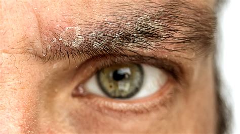 Eyebrow Dandruff: Symptoms, Treatment, and Images - GoodRx