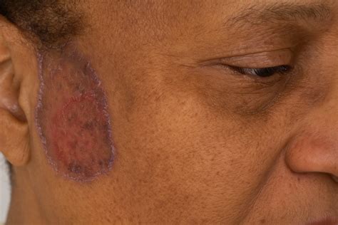 Hongos Cuero Cabelludo: Síntomas y Tratamientos Efectivos