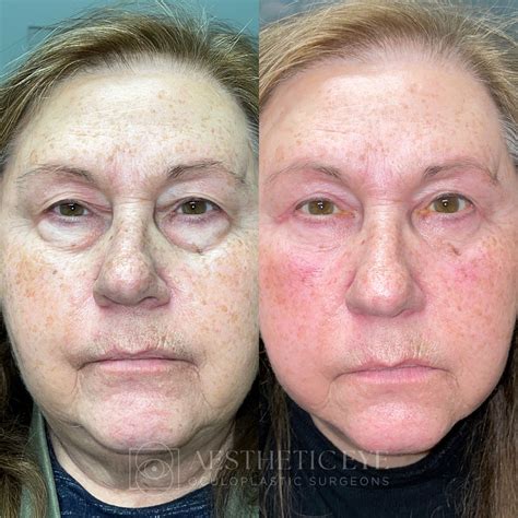 Cincinnati OH Lower Blepharoplasty | Dayton Under Eye Bags Removal Surgery