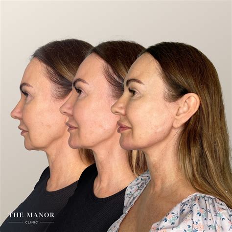 Best Filler For Jowls