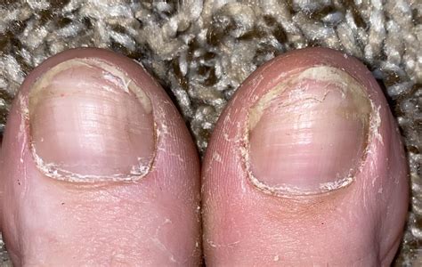 Zinc Deficiency Toenails at Alma Jones blog