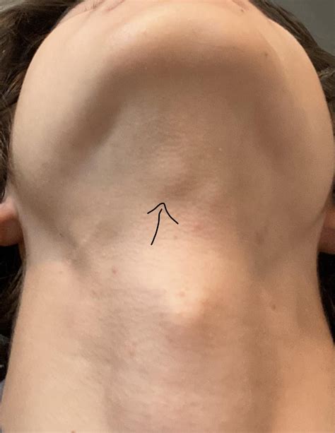 Small lump under chin above adams apple : r/medical