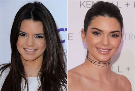 Kendall Jenner, Before and After | Kendall jenner plastic surgery, Kendall jenner face, Kendall ...