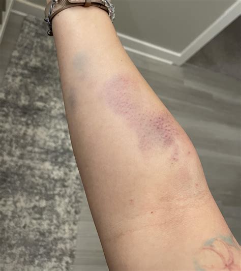 Plasma Donation Gone Wrong