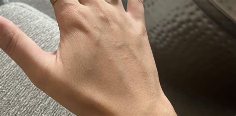 ¿Does anyone know what are these little bumps in my skin, and why do they form? I just cant get ...