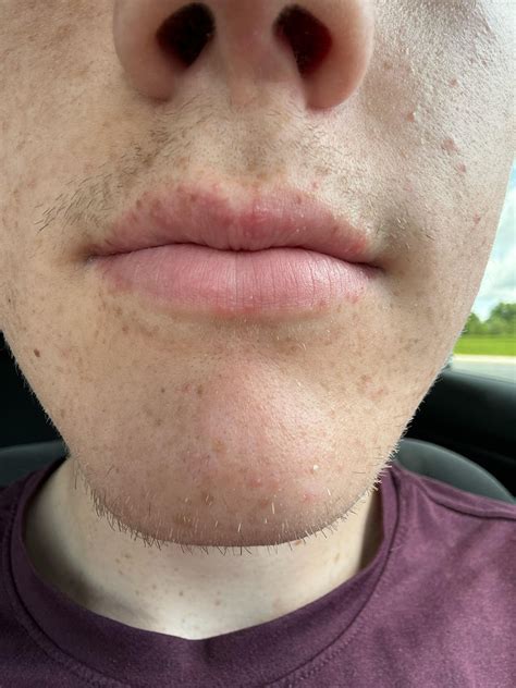 Small slightly itchy/burning bumps on lips : r/DermatologyQuestions