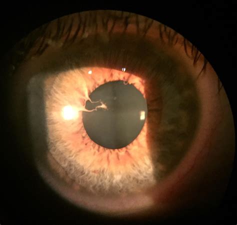 Membrana Pupilar Persistente Treating Persistent Pupillary Membranes
