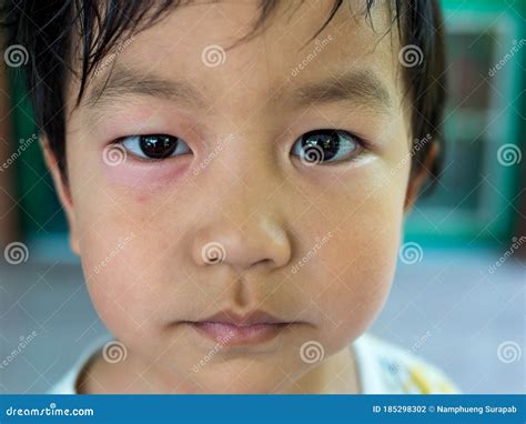 Mosquito Bite Allergy Eye