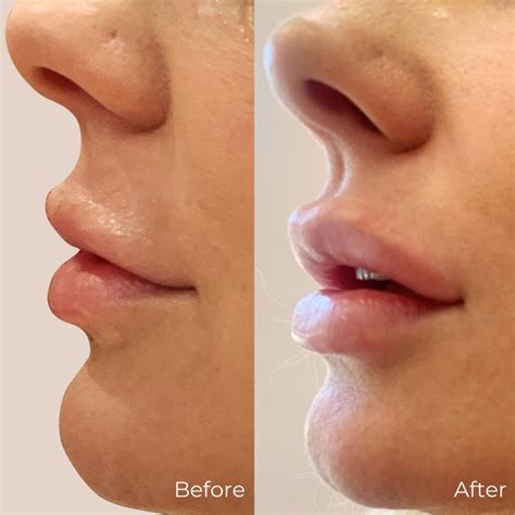 Lip Filler Before and After: Pictures and Comprehensive Guide