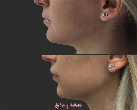 Jawline Fillers - Before & After Results at Skinly
