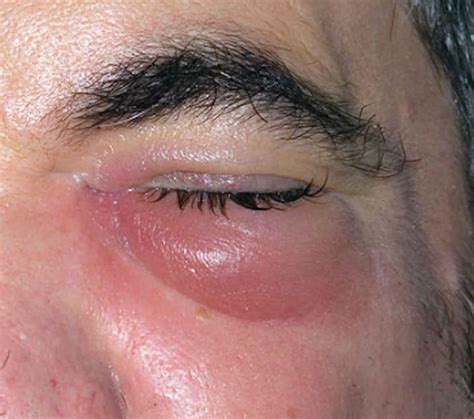 Cellulitis eye, causes, signs, symptoms, diagnosis, treatment & prognosis
